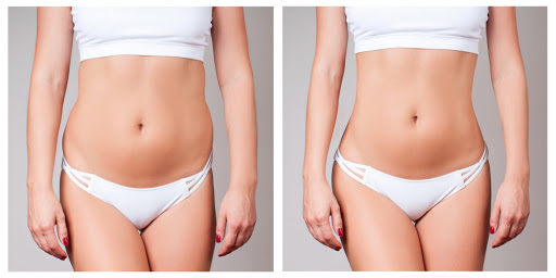 Abdominoplastia recuperação, chega de dúvidas! Especialistas reúnem o que você precisa saber para ter sucesso neste período.